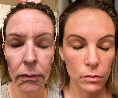 Botox Bee Venom Wrinkle Removal Cream