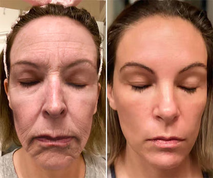 Botox Bee Venom Wrinkle Removal Cream