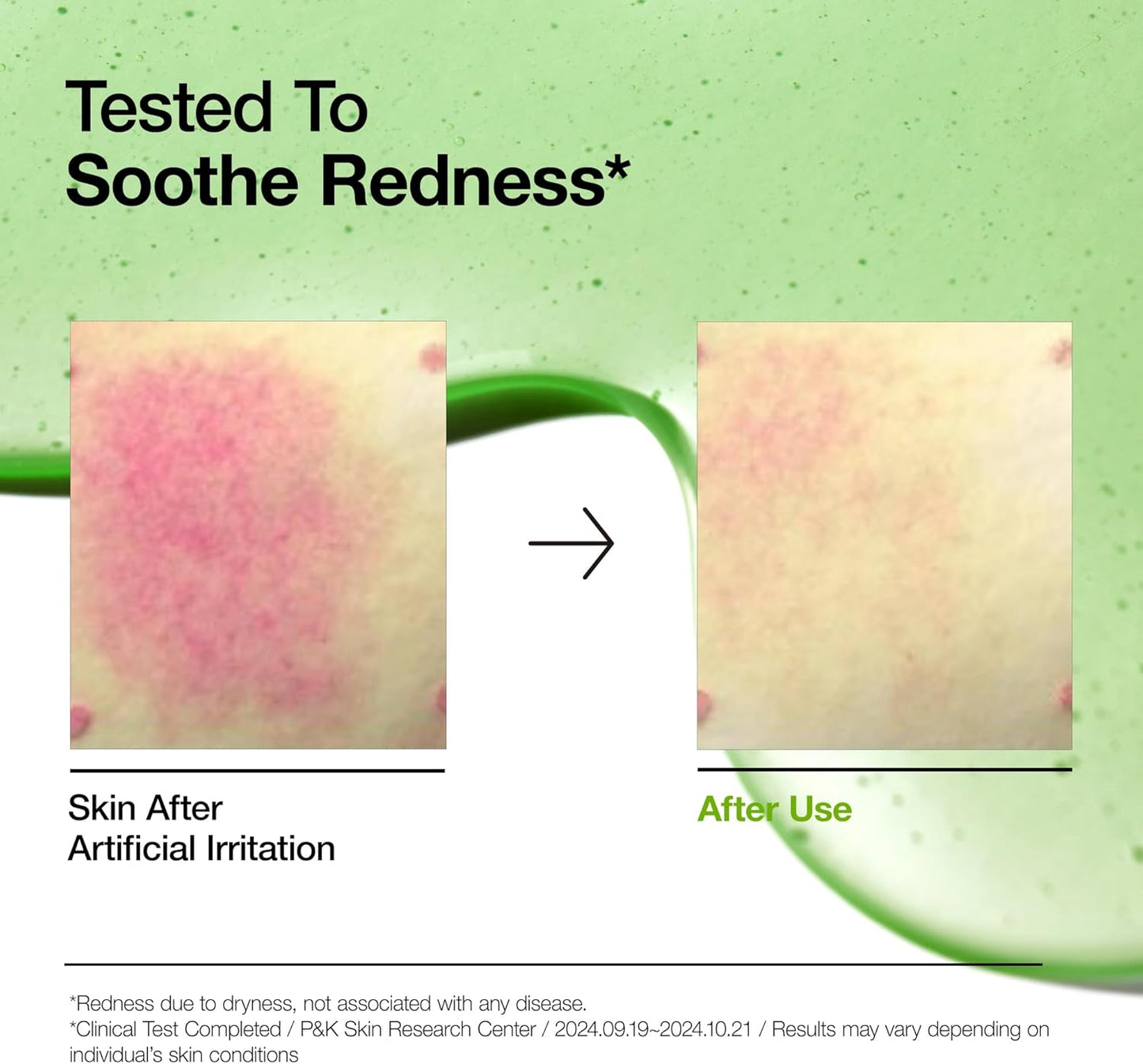 ANUA Redness Soothing Serum – Azelaic Acid & Niacinamide (30ml)